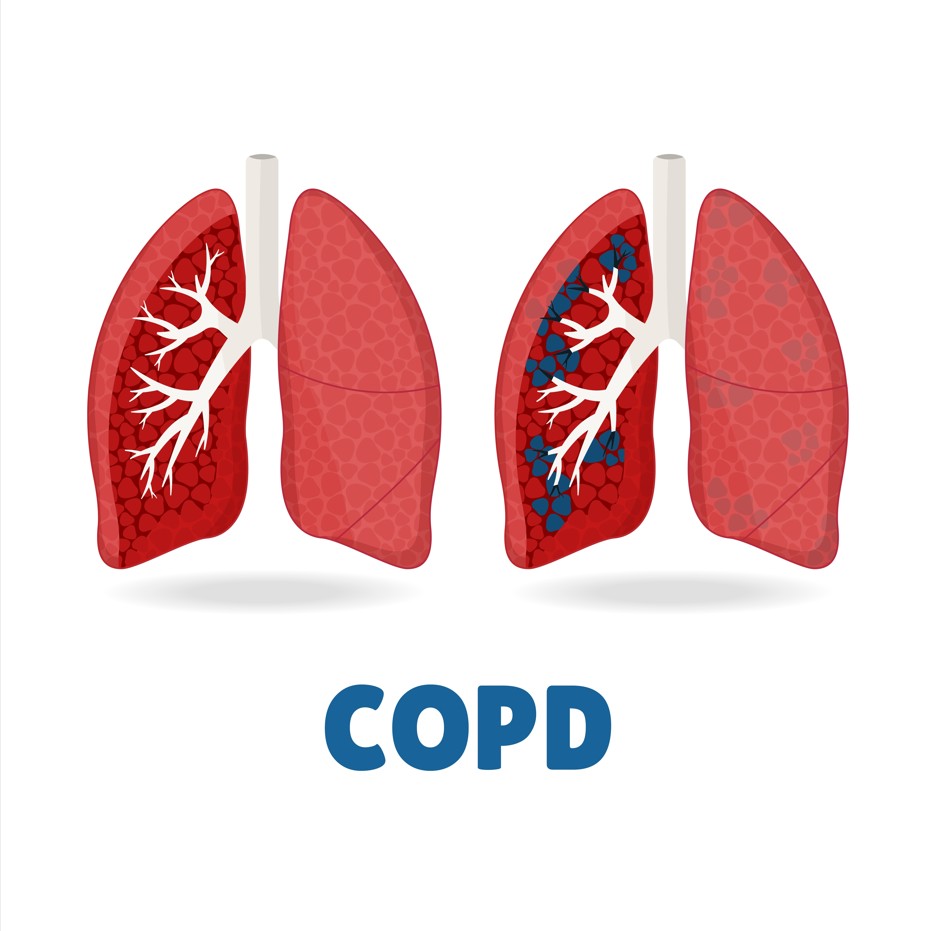 COPD